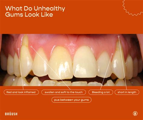 What Do Healthy Gums Look Like vs Unhealthy: A Journey Through Oral Health and Beyond